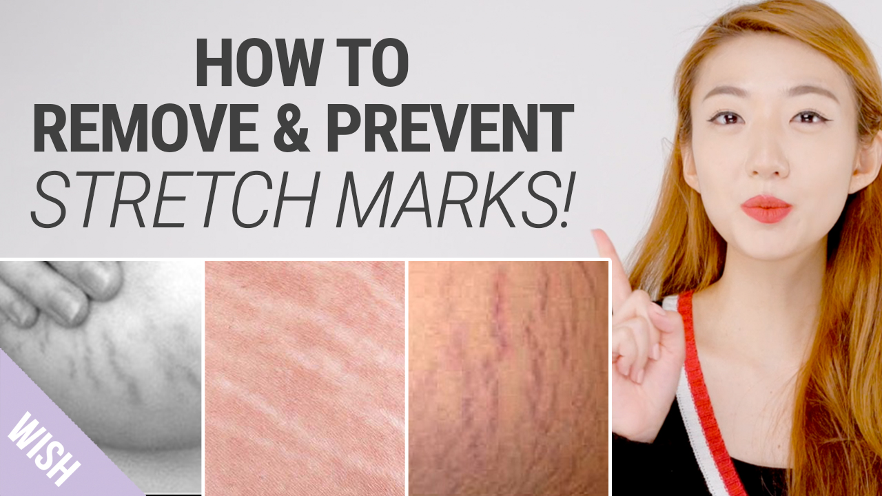 How To Get Rid of Stretch Marks Fast - Natural Remedies for Stretch Mark Removal - What's TRENDing - ___